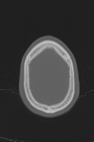 File:Anterior nasal spine fracture (Radiopaedia 46138-50494 Axial bone window 11).png