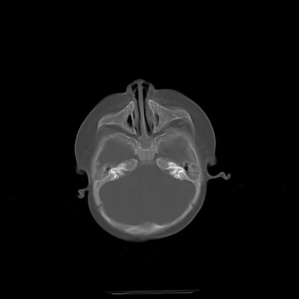 File:Anterior plagiocephaly (Radiopaedia 71836-82273 Axial bone window 3).jpg