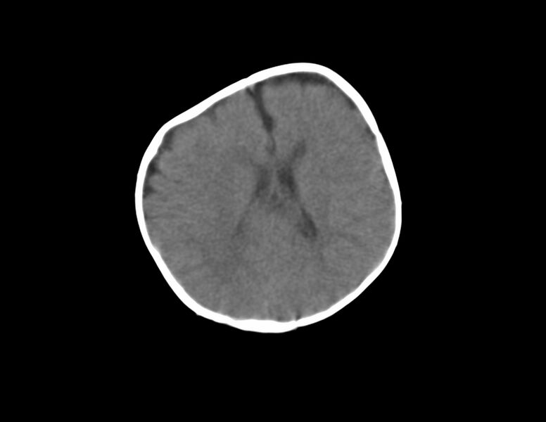 File:Anterior plagiocephaly (Radiopaedia 71836-82273 Axial non-contrast 13).jpg