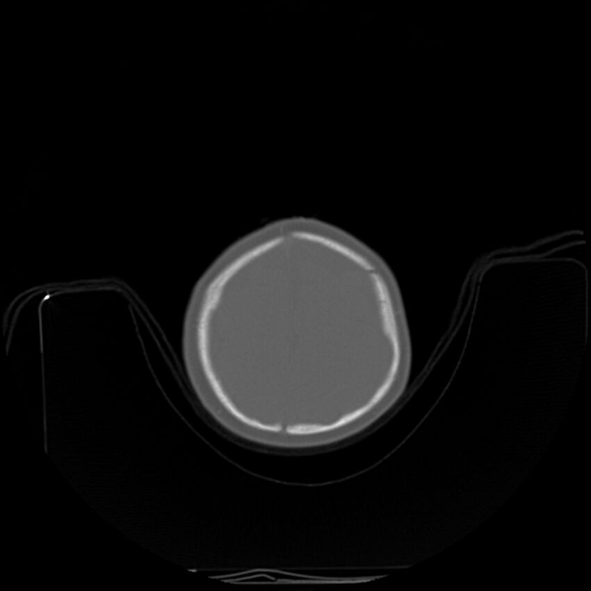Anterior plagiocephaly (Radiopaedia 71836-82273 C 89).jpg