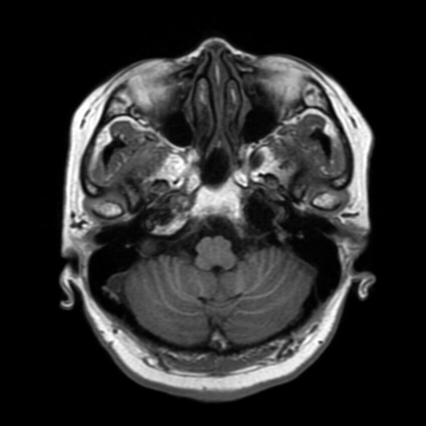 Anti-MOG encephalomyelitis (Radiopaedia 73831-84646 Axial T1 11).jpg