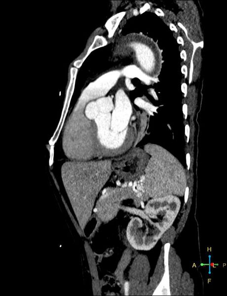 File:Aortic aneurysm and penetrating ulcer (Radiopaedia 23590-23704 C 1).jpg
