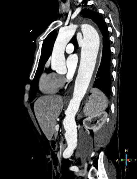 File:Aortic aneurysm and penetrating ulcer (Radiopaedia 23590-23704 C 14).jpg