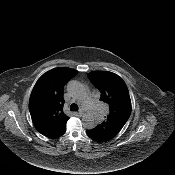 File:Aortic arch false aneurysm (Radiopaedia 14667-14587 Axial non-contrast 15).jpg