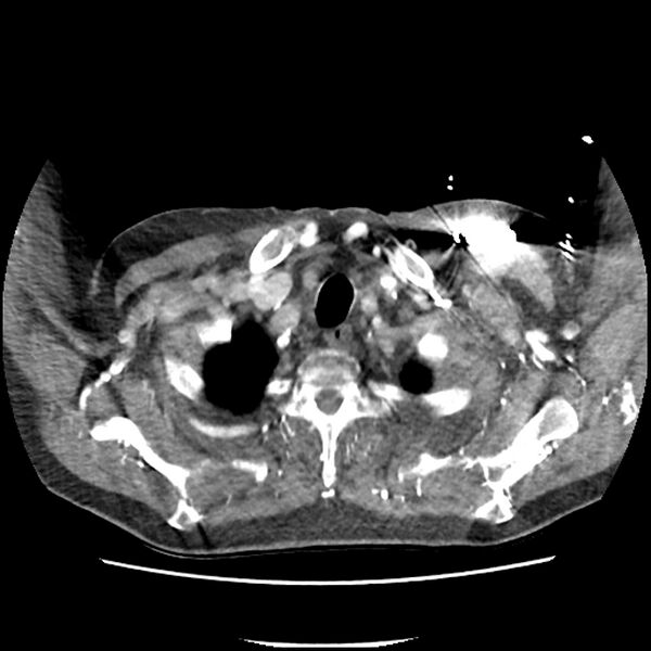 File:Aortic arch graft infection (FDG PET-CT) (Radiopaedia 71975-82437 A 3).jpg