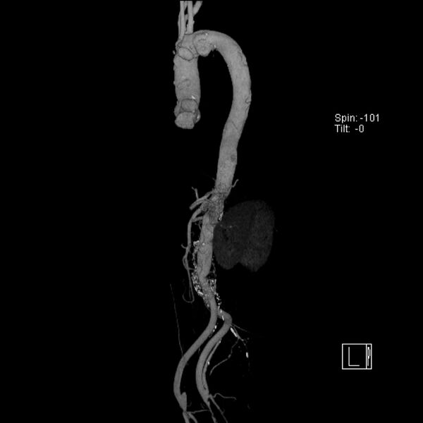 File:Aortic arch saccular aneurysm (Radiopaedia 19430-19457 A 6).jpg