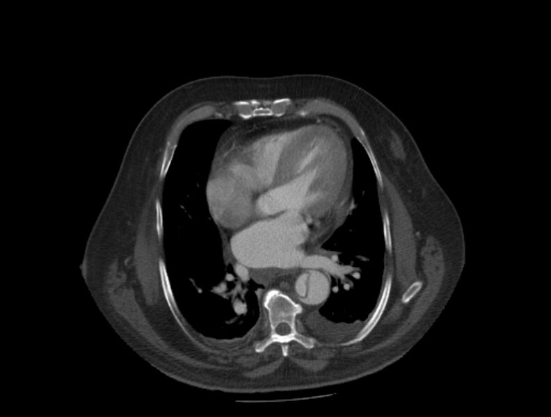 File:Aortic dissection (Radiopaedia 28802-29105 A 24).jpg