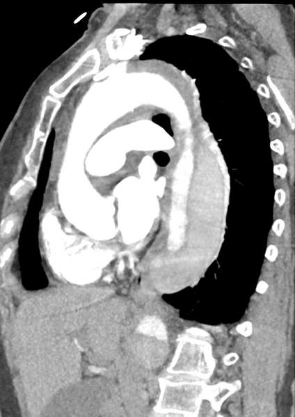 File:Aortic dissection - Stanford type B (Radiopaedia 50171-55512 C 25).png