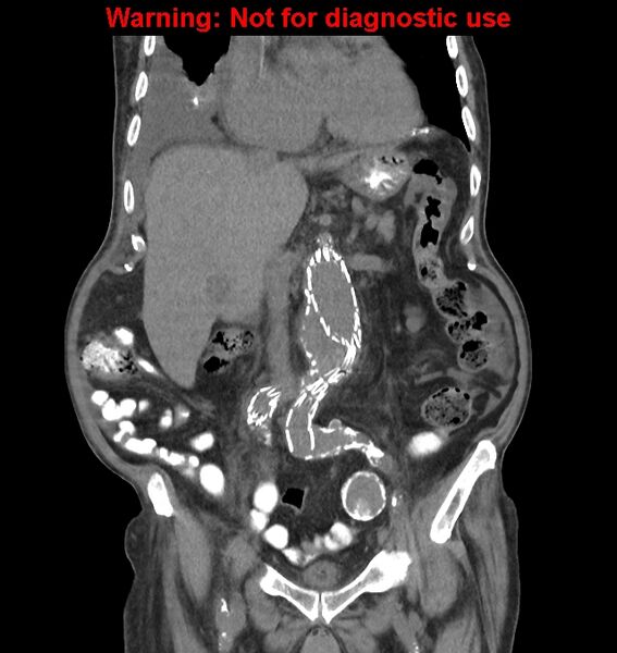 File:Aortic graft infection (Radiopaedia 44979-48907 non-contrast 23).jpg