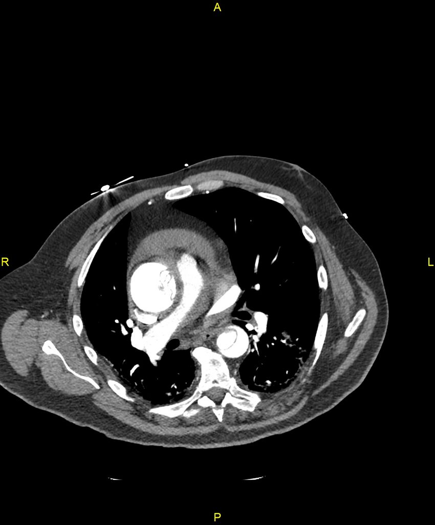 Aortic rupture (Radiopaedia 88822-105594 B 116).jpg