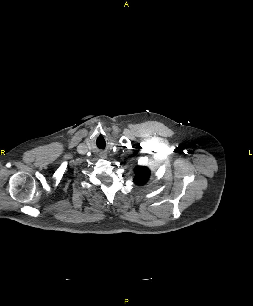 Aortic rupture (Radiopaedia 88822-105594 B 9).jpg