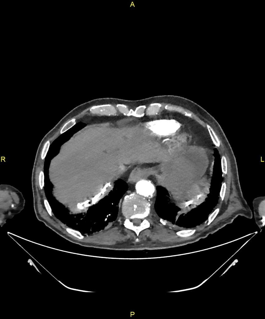 Aortoenteric fistula (Radiopaedia 84308-99603 B 22).jpg