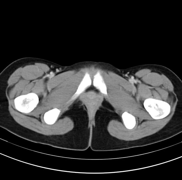 File:Appendicitis and incidental bicornuate uterus (Radiopaedia 22833-22853 B 49).jpg