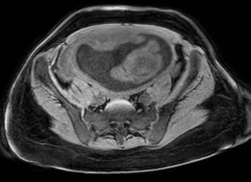 File:Appendicitis in gravida (MRI) (Radiopaedia 89433-106395 Axial DIXON 107).jpg