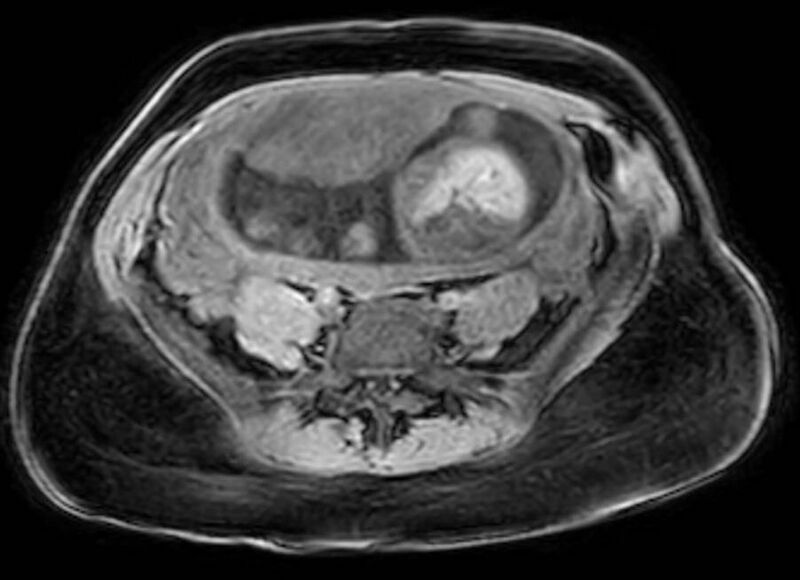 File:Appendicitis in gravida (MRI) (Radiopaedia 89433-106395 Axial DIXON 97).jpg