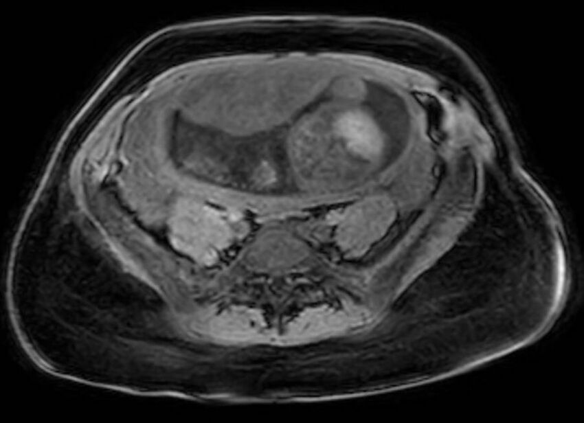 Appendicitis in gravida (MRI) (Radiopaedia 89433-106395 Axial DIXON 99).jpg