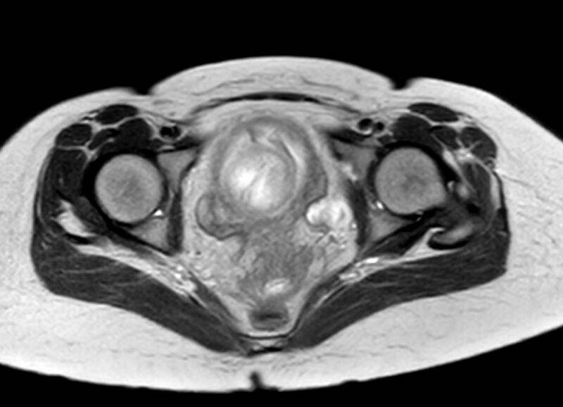 File:Appendicitis in gravida (MRI) (Radiopaedia 89433-106395 Axial T2 66).jpg