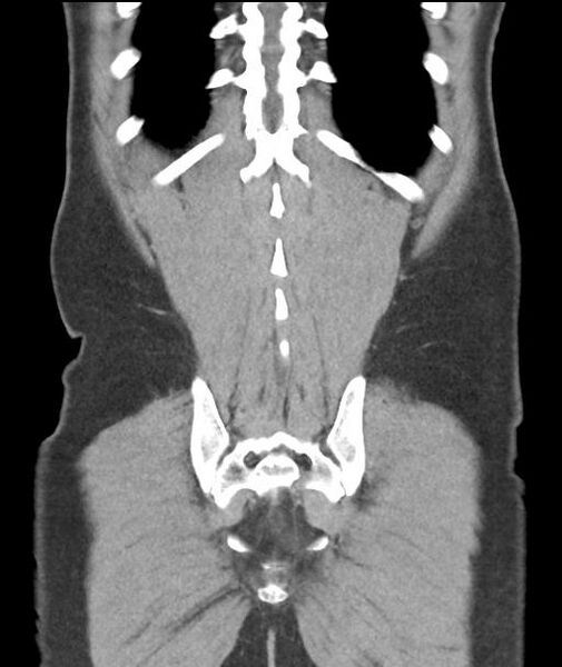 File:Appendicitis with cecal bar sign (Radiopaedia 31878-32830 A 52).jpg