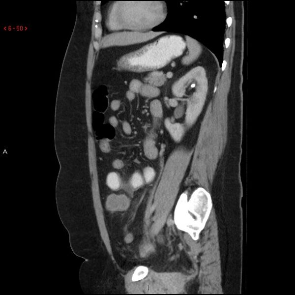 File:Appendicitis with microperforation- promontoric type (Radiopaedia 27268-27442 A 35).jpg