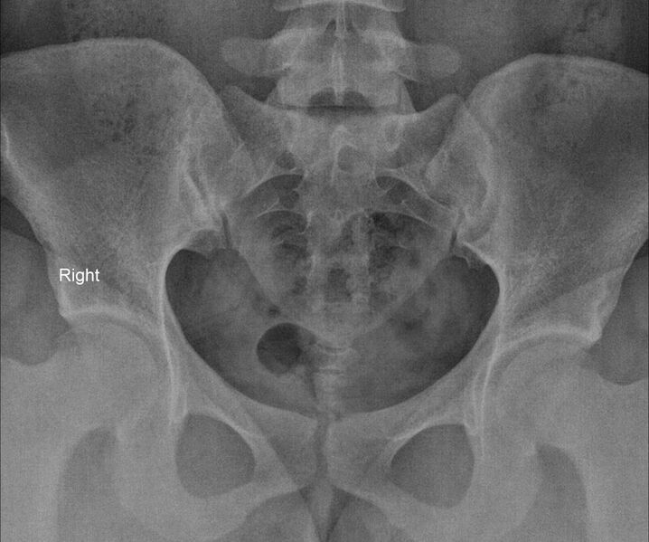 File:Arcuate uterus (Radiopaedia 87335-103630 Frontal 1).jpg
