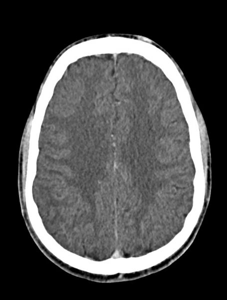 File:Arrow injury to the face (Radiopaedia 73267-84011 Axial C+ delayed 64).jpg