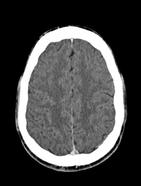 File:Arrow injury to the face (Radiopaedia 73267-84011 Axial C+ delayed 67).jpg