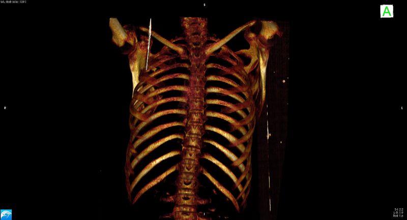 File:Arrow injury to the neck (Radiopaedia 75225-86323 3D bone 2).jpg