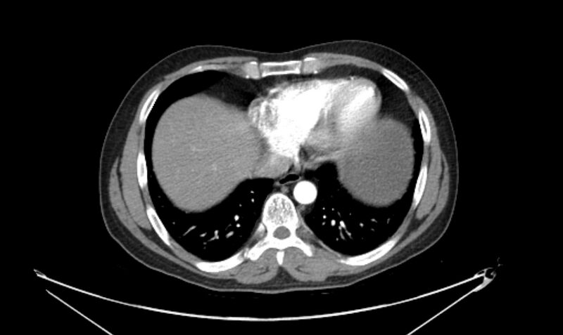 File:Arterial occlusive mesenteric ischemia (Radiopaedia 84641-100060 A 15).jpg