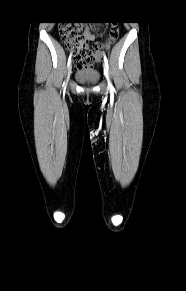 File:Arteriovenous malformation of the thigh (Radiopaedia 14948-14883 C+ arterial phase 3).jpg