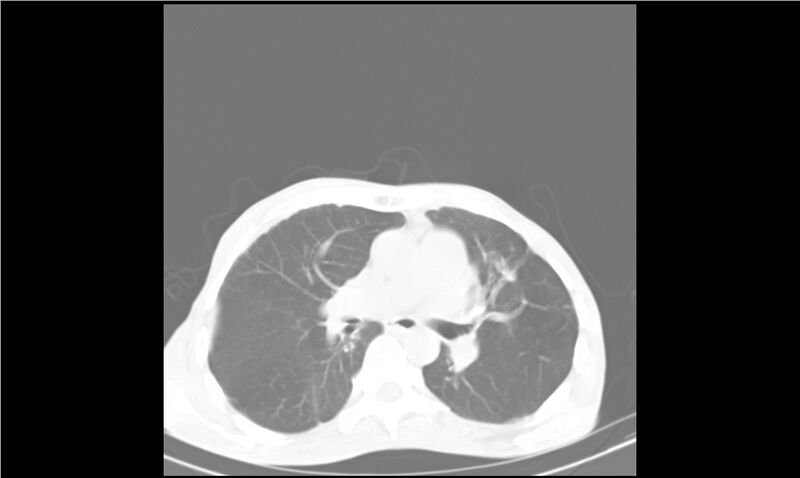 File:Aspergilloma (Radiopaedia 20788-20701 Axial lung window 17).jpg