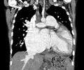 Atrial septal defect complicated by Eisenmenger syndrome (Radiopaedia 53707-59768 Coronal C+ CTPA 11).jpg