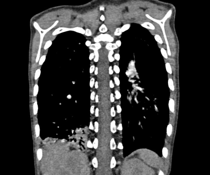 File:Atrial septal defect complicated by Eisenmenger syndrome (Radiopaedia 53707-59768 Coronal C+ CTPA 18).jpg