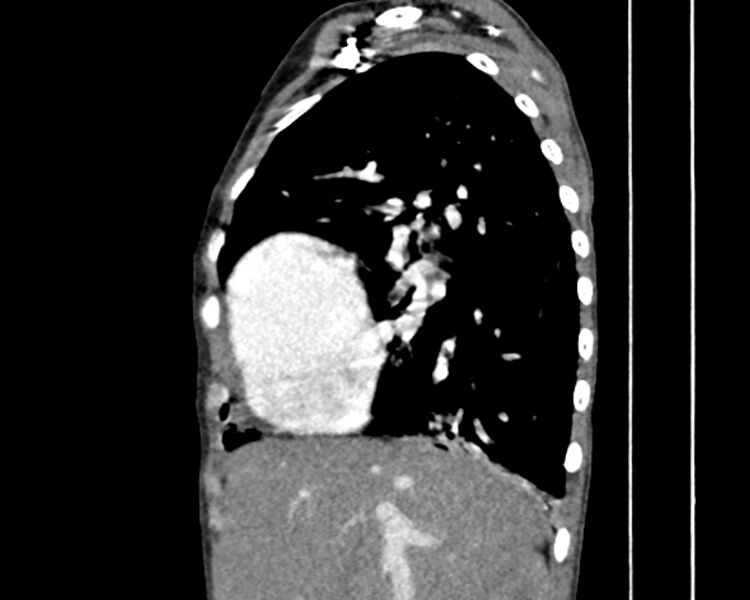 File:Atrial septal defect complicated by Eisenmenger syndrome (Radiopaedia 53707-59768 Sagittal C+ CTPA 7).jpg