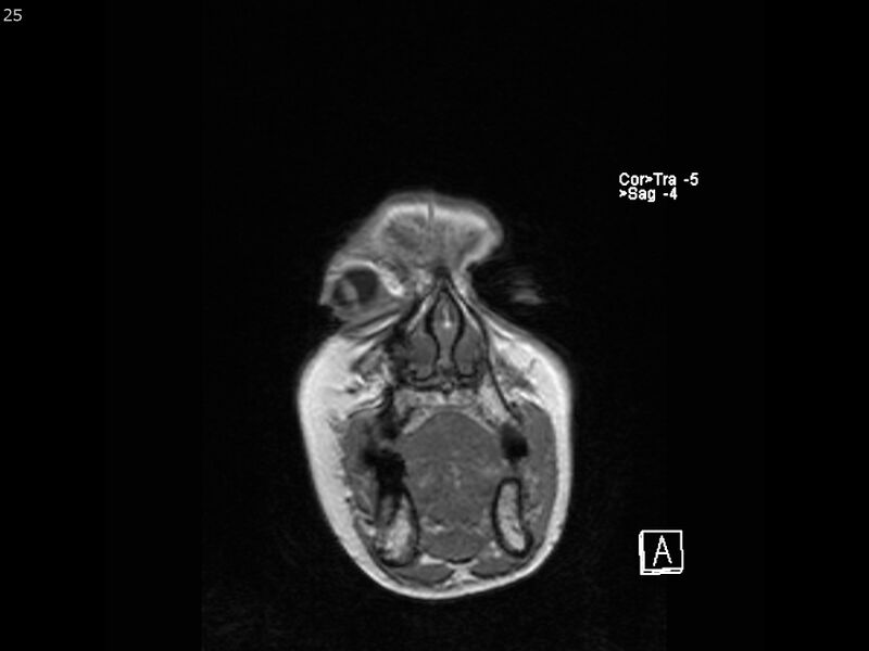 File:Atypical meningioma - intraosseous (Radiopaedia 64915-74572 Coronal T1 25).jpg