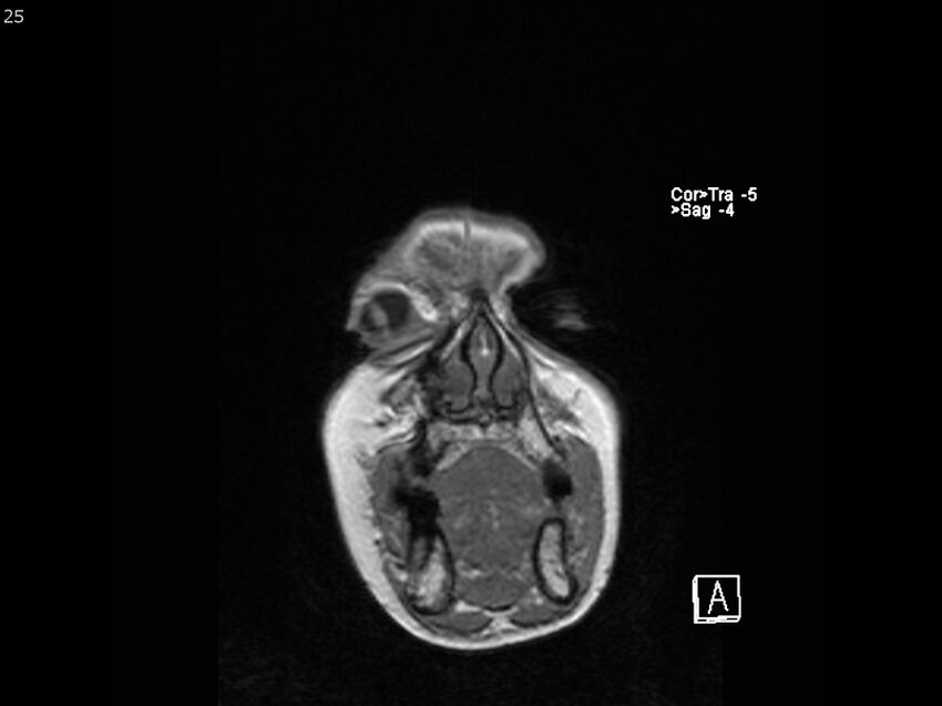 Atypical meningioma - intraosseous (Radiopaedia 64915-74572 Coronal T1 25).jpg