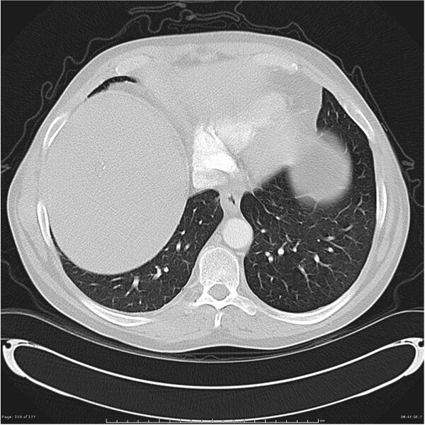 File:Atypical pneumonia - Q fever (Radiopaedia 21993-21989 lung window 38).jpg