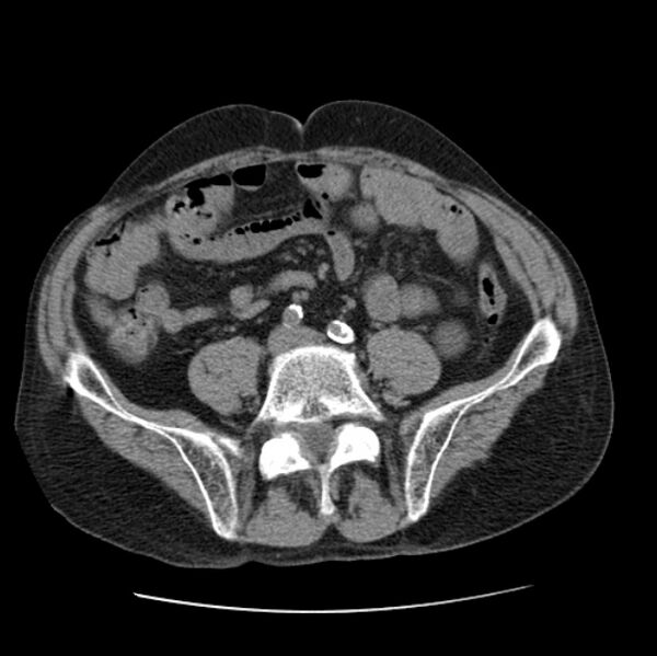 File:Autosomal dominant polycystic kidney disease (Radiopaedia 27851-28094 Axial non-contrast 88).jpg