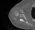 Avulsion fracture - greater tuberosity of humerus (Radiopaedia 71216-81514 Axial bone window 27).jpg