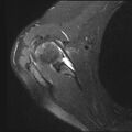 Avulsion fracture - greater tuberosity of humerus (Radiopaedia 71216-81515 Axial PD fat sat 13).jpg
