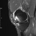 Avulsion fracture of the fibular head (Radiopaedia 74804-85808 Sagittal PD fat sat 10).jpg