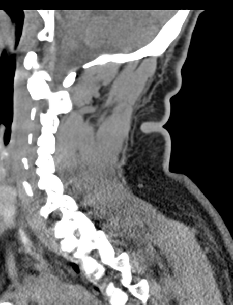 File:Axis peg fracture (type 3) and atlas lateral mass (type 4) fracture (Radiopaedia 37474-39324 D 30).png