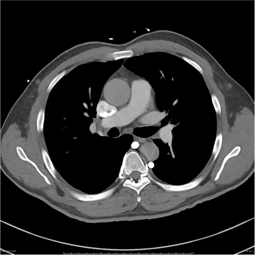 Azygos venous system anatomy (CT pulmonary angiography) (Radiopaedia 25928-26077 Axial C+ CTPA 38).jpg