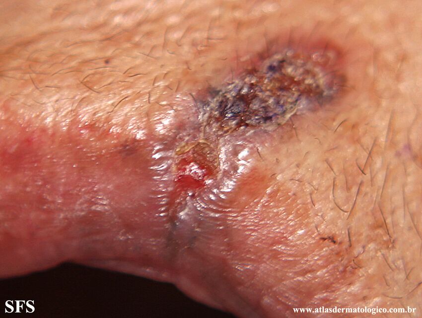 Basal Cell Carcinoma (Dermatology Atlas 308).jpg