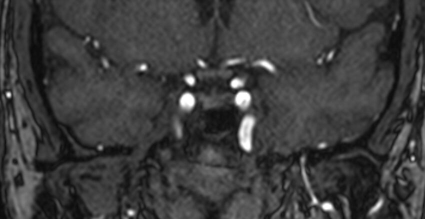 Basilar artery fenestration (Radiopaedia 74537-85455 Coronal MRA TOF 10).jpg