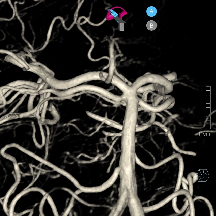 Basilar artery perforator aneurysm (Radiopaedia 82455-97734 3D view left VA 122).jpg