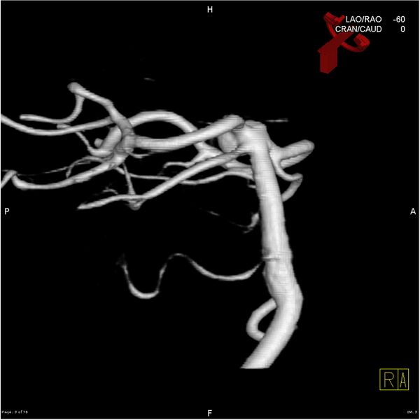 File:Basilar tip aneurysm double balloon remodeling (Radiopaedia 18100-17883 3D rotation 3).jpg