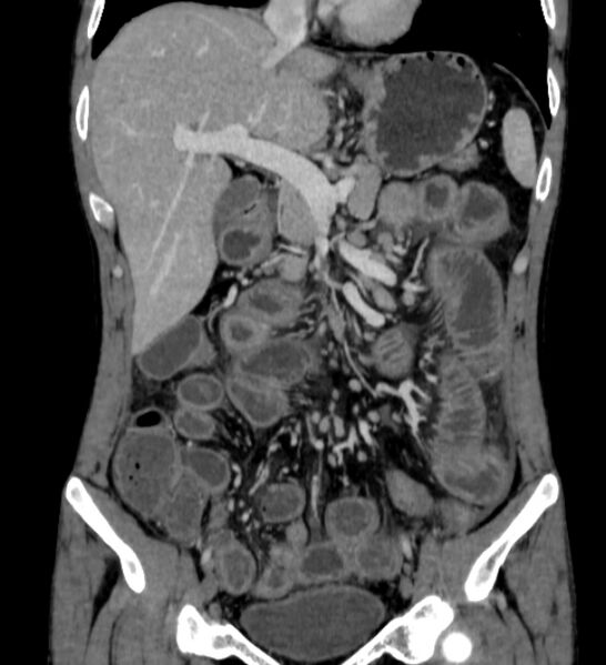 File:Behçet's disease- abdominal vasculitis (Radiopaedia 55955-62570 B 21).jpg