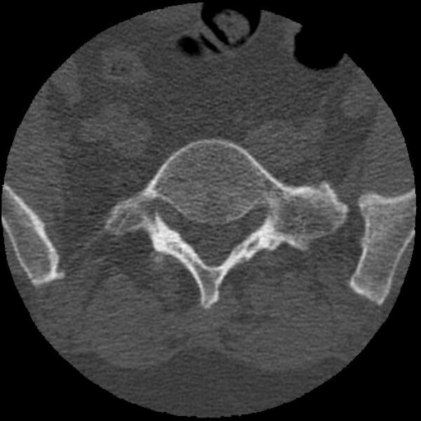 File:Bertolotti syndrome (Radiopaedia 24864-25128 Axial bone window 16).jpg