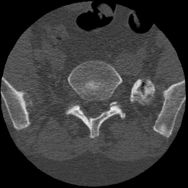 File:Bertolotti syndrome (Radiopaedia 24864-25128 Axial bone window 21).jpg