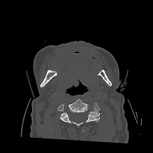 File:Bilateral Le Fort fractures (Radiopaedia 32192-33135 Axial bone window 20).jpg